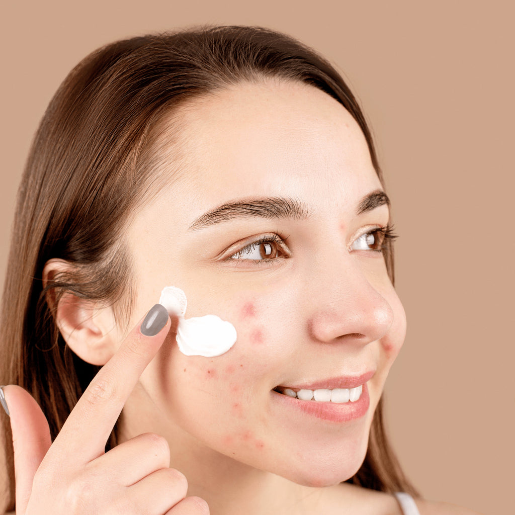 Cum aleg produsele cosmetice potrivite tenului acneic?