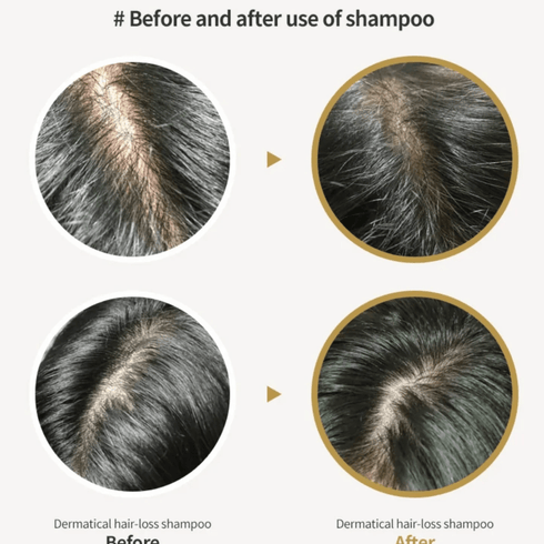 Lador Dermatical Hair Loss Shampoo For Thin Hair -200 ml